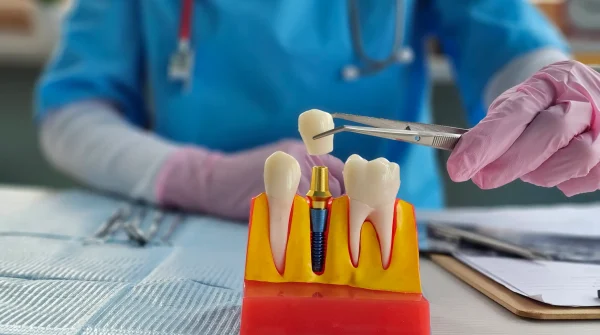 Modell eines Implantats ersetzt einen fehlenden Zahn, Zahnarzt demonstriert den Aufbau mit Pinzette, Fokus auf Zahnzusatzversicherung.